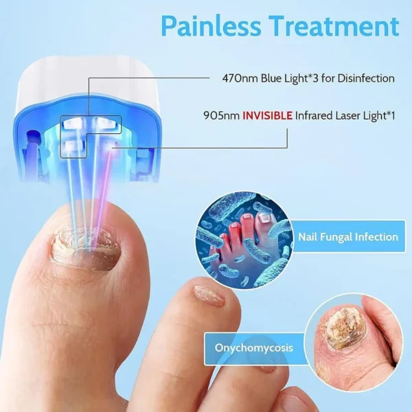 Dispositivo a Laser para tratamento de fungo e reparação das unhas, eficaz na remoção de micose e fungos. - Image 3