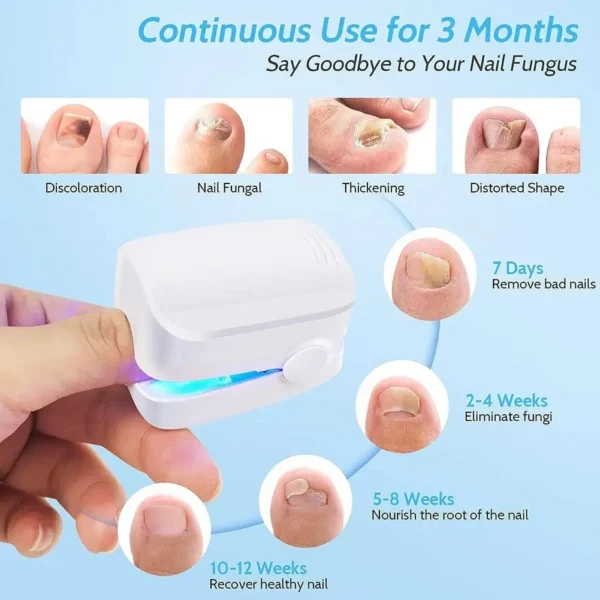 Dispositivo a Laser para tratamento de fungo e reparação das unhas, eficaz na remoção de micose e fungos. - Image 4